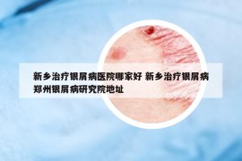 新鄉(xiāng)治療銀屑病醫(yī)院哪家好 新鄉(xiāng)治療銀屑病鄭州銀屑病研究院地址