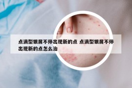 點(diǎn)滴型銀屑不停出現(xiàn)新的點(diǎn) 點(diǎn)滴型銀屑不停出現(xiàn)新的點(diǎn)怎么治