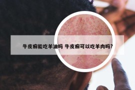 牛皮癬能吃羊油嗎 牛皮癬可以吃羊肉嗎?