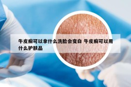 牛皮癬可以拿什么洗臉會變白 牛皮癬可以用什么護(hù)膚品