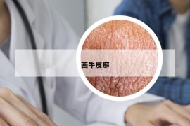 畫(huà)牛皮癬