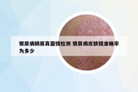銀屑病鱗屑真菌鏡檢測 銀屑病皮膚鏡準確率為多少