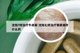 沈陽(yáng)7院治療牛皮癬 沈陽(yáng)七院治療銀屑病開什么藥