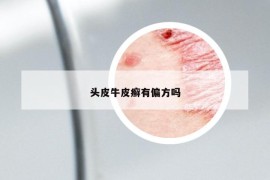 頭皮牛皮癬有偏方嗎
