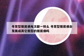 尋常型銀屑病每次都一樣么 尋常型銀屑病會發(fā)展成其它類型的銀屑病嗎