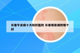 長(zhǎng)春牛皮癬十大較好醫(yī)院 長(zhǎng)春銀屑病院哪個(gè)好