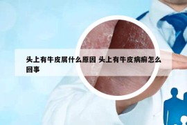 頭上有牛皮屑什么原因 頭上有牛皮病癬怎么回事