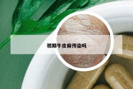 初期牛皮癬傳染嗎