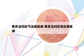 黃芪當(dāng)歸白芍治銀屑病 黃芪當(dāng)歸生地白銀屑病