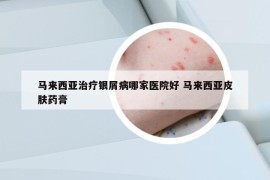 馬來西亞治療銀屑病哪家醫(yī)院好 馬來西亞皮膚藥膏