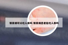 銀屑病可以吃人參嗎 銀屑病患者能吃人參嗎