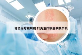 針灸治療銀屑病 針灸治療銀屑病關(guān)節(jié)炎