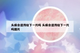 頭癬會(huì)遺傳給下一代嗎 頭癬會(huì)遺傳給下一代嗎圖片