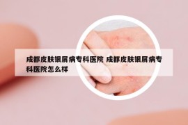 成都皮膚銀屑病?？漆t(yī)院 成都皮膚銀屑病?？漆t(yī)院怎么樣
