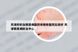 天津好的治銀屑病醫(yī)院有哪些醫(yī)院比較好 天津銀屑病防治中心