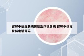 邯鄲中信皮膚病醫(yī)院治療銀屑病 邯鄲中信皮膚科電話號(hào)碼
