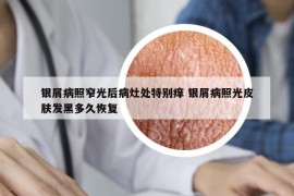 銀屑病照窄光后病灶處特別癢 銀屑病照光皮膚發(fā)黑多久恢復(fù)