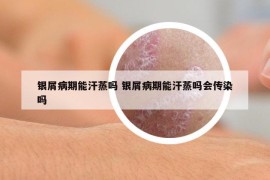 銀屑病期能汗蒸嗎 銀屑病期能汗蒸嗎會傳染嗎