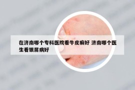 在濟(jì)南哪個(gè)專科醫(yī)院看牛皮癬好 濟(jì)南哪個(gè)醫(yī)生看銀屑病好