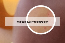 牛皮癬怎么治療只有西安北方
