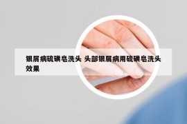 銀屑病硫磺皂洗頭 頭部銀屑病用硫磺皂洗頭效果