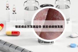 銀屑病自然發(fā)展趨勢(shì) 銀屑病病情發(fā)展