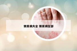 銀屑病大全 銀屑病全部