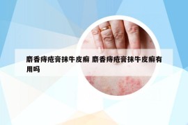 麝香痔瘡膏抹牛皮癬 麝香痔瘡膏抹牛皮癬有用嗎