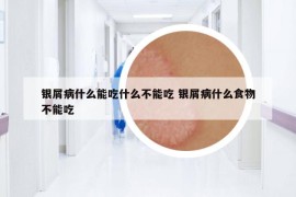 銀屑病什么能吃什么不能吃 銀屑病什么食物不能吃
