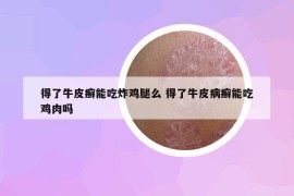 得了牛皮癬能吃炸雞腿么 得了牛皮病癬能吃雞肉嗎