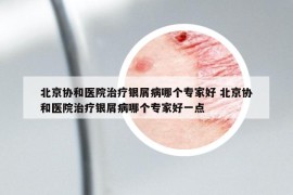 北京協和醫(yī)院治療銀屑病哪個專家好 北京協和醫(yī)院治療銀屑病哪個專家好一點