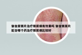 郁金屑銀片治療銀屑病有效果嗎 郁金銀屑片配合哪個(gè)藥治療銀屑病比較好
