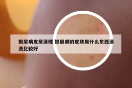 銀屑病皮屑清理 銀屑病的皮膚用什么東西清洗比較好