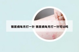 銀屑病每月打一針 銀屑病每月打一針可以嗎