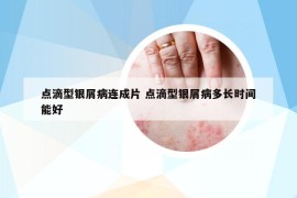 點(diǎn)滴型銀屑病連成片 點(diǎn)滴型銀屑病多長(zhǎng)時(shí)間能好