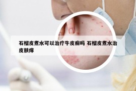 石榴皮煮水可以治療牛皮癬嗎 石榴皮煮水治皮膚癢