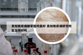 貴陽銀屑病哪家醫(yī)院最好 貴陽銀屑病研究院能治得好嗎