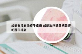 成都有沒有治療牛皮癬 成都治療銀屑病最好的醫(yī)生排名