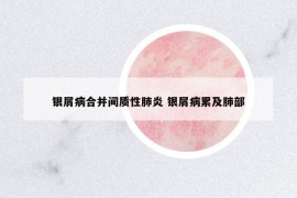 銀屑病合并間質(zhì)性肺炎 銀屑病累及肺部