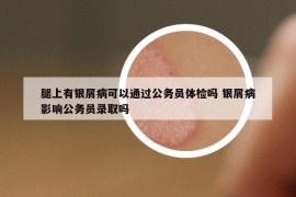 腿上有銀屑病可以通過公務(wù)員體檢嗎 銀屑病影響公務(wù)員錄取嗎