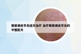 銀屑病關節(jié)炎經(jīng)方治療 治療銀屑病關節(jié)炎的中醫(yī)配方