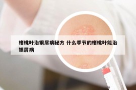 楮桃葉治銀屑病秘方 什么季節(jié)的楮桃葉能治銀屑病
