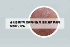 連云港最好牛皮癬專科醫(yī)院 連云港皮膚病?？漆t(yī)院正規(guī)嗎