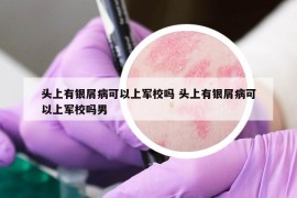 頭上有銀屑病可以上軍校嗎 頭上有銀屑病可以上軍校嗎男
