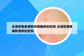 點滴狀銀屑病和玫瑰糠疹的區(qū)別 點滴型銀屑病和濕疹的區(qū)別