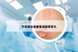 牛皮癬全身都是消掉得多久