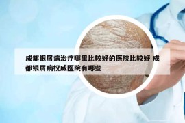 成都銀屑病治療哪里比較好的醫(yī)院比較好 成都銀屑病權(quán)威醫(yī)院有哪些