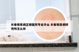 長(zhǎng)春銀屑病正規(guī)醫(yī)院專業(yè)華山 長(zhǎng)春銀屑病研究所怎么樣
