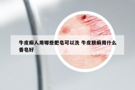 牛皮癬人用哪些肥皂可以洗 牛皮膚癬用什么香皂好