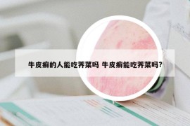 牛皮癬的人能吃薺菜嗎 牛皮癬能吃薺菜嗎?